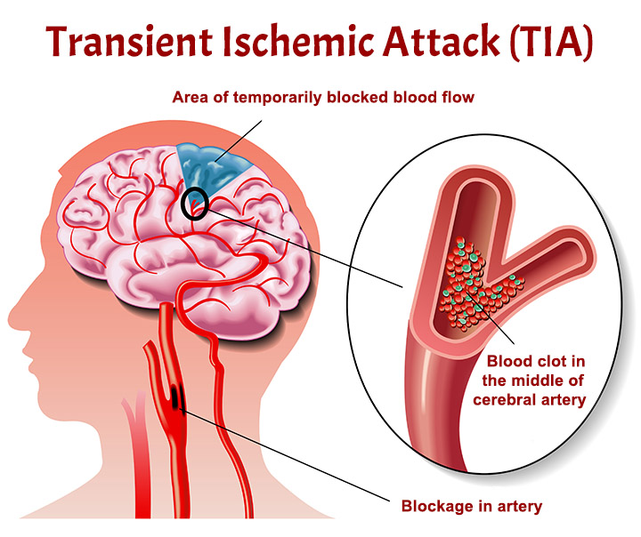 Transient Ischemic Attacks